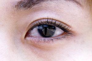 腫れないと話題の二重整形が出来る